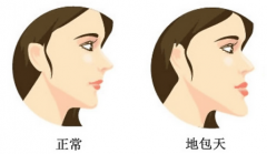 地包天带来的危害有哪些?