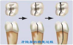 牙齿开裂的原因及治疗方法