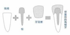 牙齿缺失了 三种修复手段 哪种较好