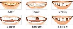 牙齿修复不良体的危害