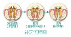 补牙时为什么还要磨牙齿