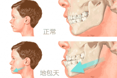 如何判断地包天